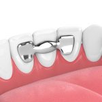 Why Maryland Bridge Can Be a Great Replacement for an Implant